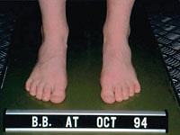 leg length correction